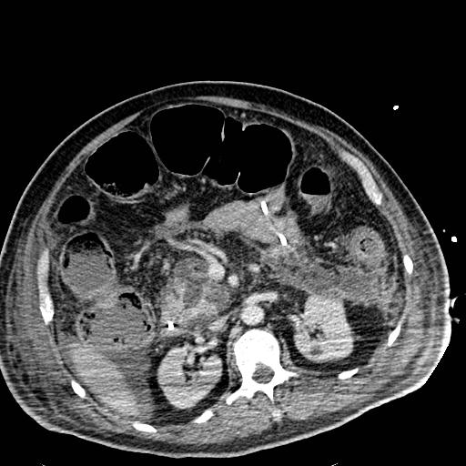 Acute pancreatic necrosis (Radiopaedia 13560-18501 Axial C+ portal venous phase 55).jpg