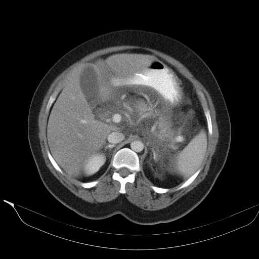 File:Acute pancreatitis (Radiopaedia 20829-20744 Axial C+ portal venous phase 15).jpg