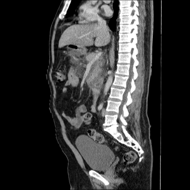 Acute pancreatitis (Radiopaedia 26663-26813 Sagittal C+ portal venous phase 36).jpg