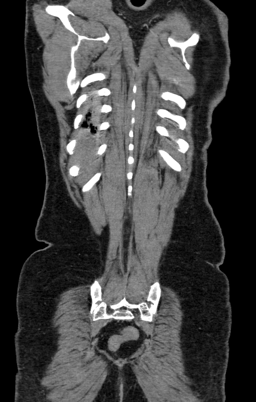 Acute pancreatitis (Radiopaedia 80007-93285 Coronal C+ portal venous phase 139).jpg
