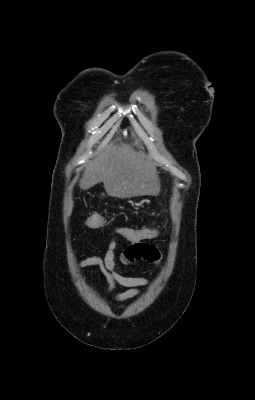 Acute pancreatitis (Radiopaedia 80007-93285 Coronal C+ portal venous phase 7).jpg