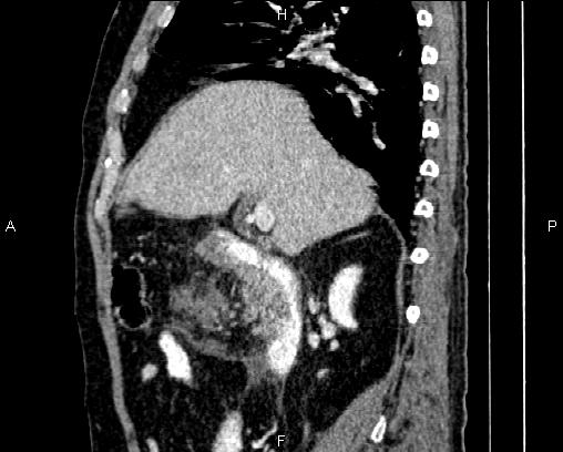 Acute pancreatitis (Radiopaedia 85146-100701 Sagittal C+ portal venous phase 32).jpg