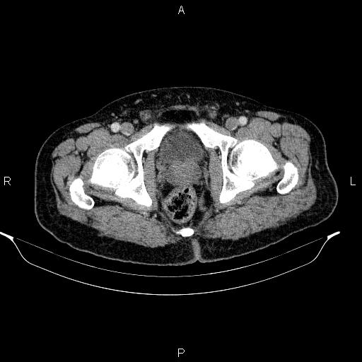 File:Acute pancreatitis (Radiopaedia 85390-101010 Axial C+ portal venous phase 107).jpg