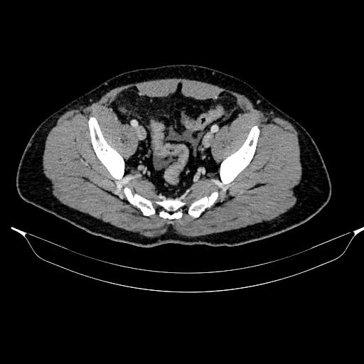 File:Acute pancreatitis (Radiopaedia 87428-103757 Axial C+ portal venous phase 83).jpg