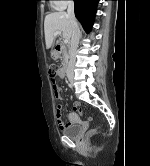 File:Acute pancreatitis - Balthazar E - post ERCP (Radiopaedia 27562-27772 Sagittal C+ portal venous phase 58).png