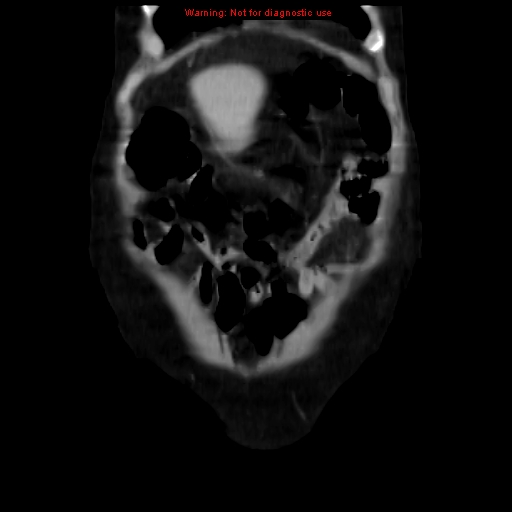 Acute pancreatitis with incidental pancreatic lipoma (Radiopaedia 10190-10730 Coronal C+ portal venous phase 9).jpg
