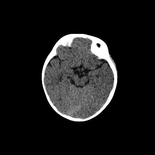 Acute phase of hemiconvulsion-hemiplegia epilepsy syndrome (Radiopaedia 29309-29744 Axial non-contrast 33).jpg