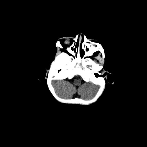 Acute phase of hemiconvulsion-hemiplegia epilepsy syndrome (Radiopaedia 29309-29744 Axial non-contrast 45).jpg
