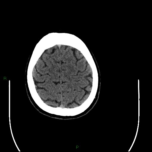 Acute posterior cerebral artery territory infarct (Radiopaedia 79329-92393 Axial non-contrast 93).jpg