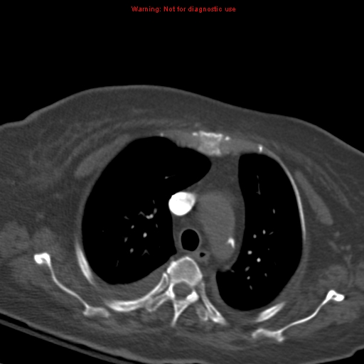 Acute pulmonary embolism (Radiopaedia 13286-13289 Axial C+ CTPA 20).jpg
