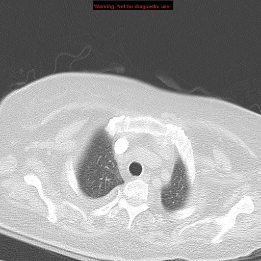 File:Acute pulmonary embolism (Radiopaedia 13286-13289 B 8).jpg