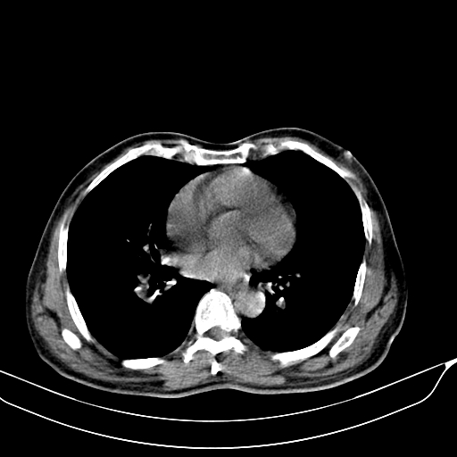 File:Acute pulmonary embolism (Radiopaedia 69510-79390 Axial non-contrast 28).jpg