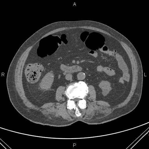 File:Acute renal artery occlusion (Radiopaedia 86586-102682 Axial non-contrast 40).jpg