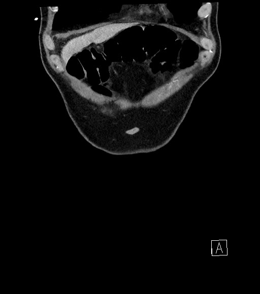 Acute renal infarction (Radiopaedia 59375-66736 Coronal C+ portal venous phase 10).jpg