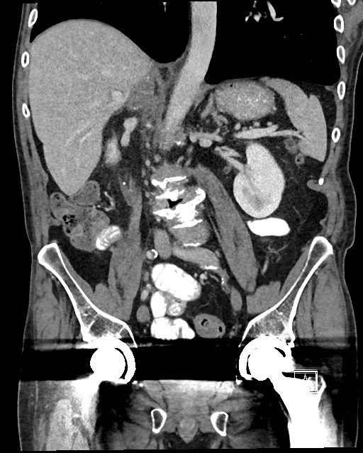 Acute renal infarction - rim capsular enhancement (Radiopaedia 59833-67270 Coronal C+ portal venous phase 31).jpg