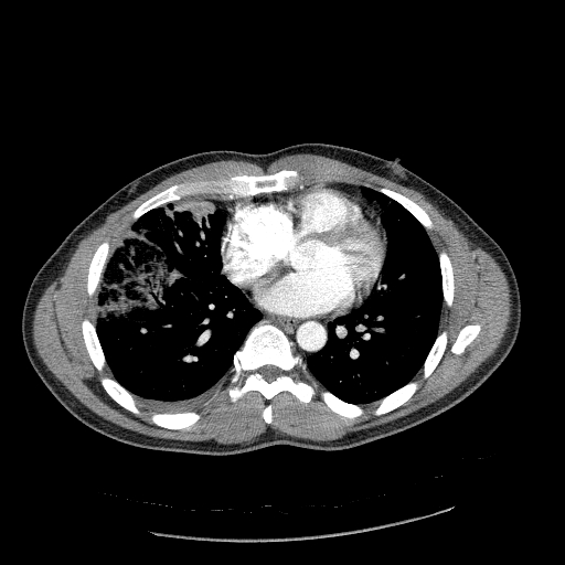 Acute segmental pulmonary emboli and pulmonary infarction (Radiopaedia 62264-70444 Axial C+ CTPA 71).jpg