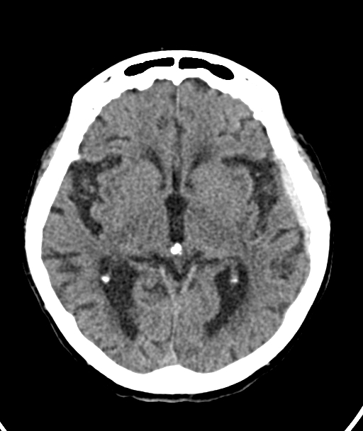 Acute traumatic subdural hematoma (Radiopaedia 82921-97257 Axial non-contrast 36).jpg