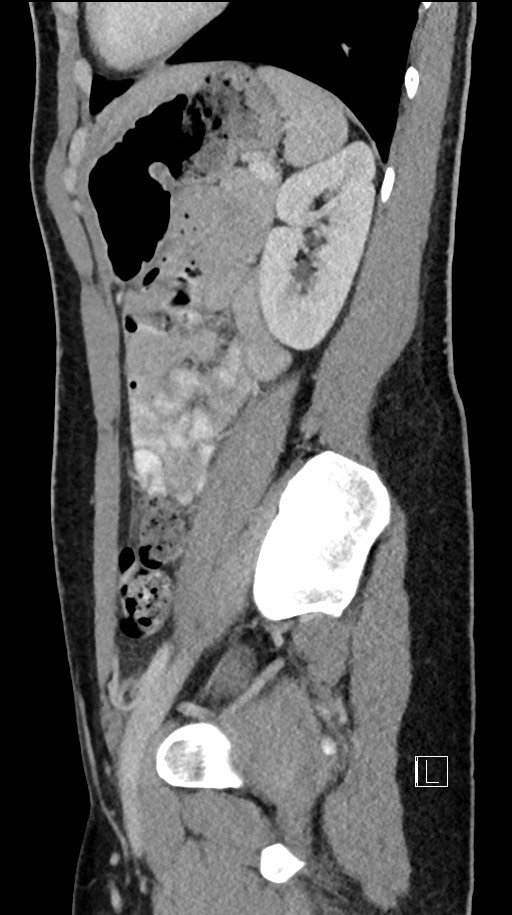 Acute uncomplicated appendicitis (Radiopaedia 61374-69304 Sagittal C+ portal venous phase 31).jpg