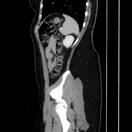 File:Acute uncomplicated appendicitis (Radiopaedia 73704-84499 Sagittal C+ portal venous phase 157).jpg