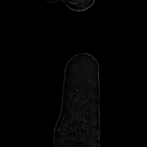 Acute uncomplicated appendicitis (Radiopaedia 73704-84499 Sagittal C+ portal venous phase 204).jpg