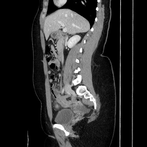 File:Acute uncomplicated appendicitis (Radiopaedia 73704-84499 Sagittal C+ portal venous phase 97).jpg
