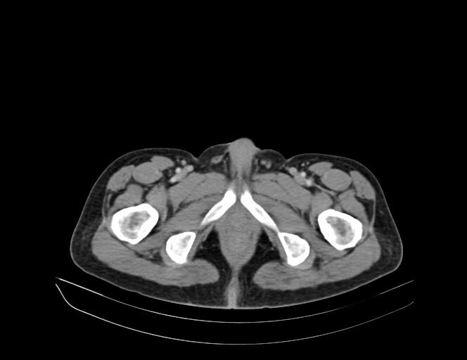 Addison disease (Radiopaedia 49318-54412 Axial C+ portal venous phase 78).jpg