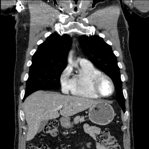 Adenocarcinoma of the lung (Radiopaedia 59871-67325 Coronal C+ arterial phase 17).jpg