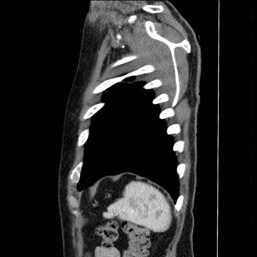 Adenocarcinoma of the lung (Radiopaedia 59871-67325 Sagittal C+ arterial phase 91).jpg