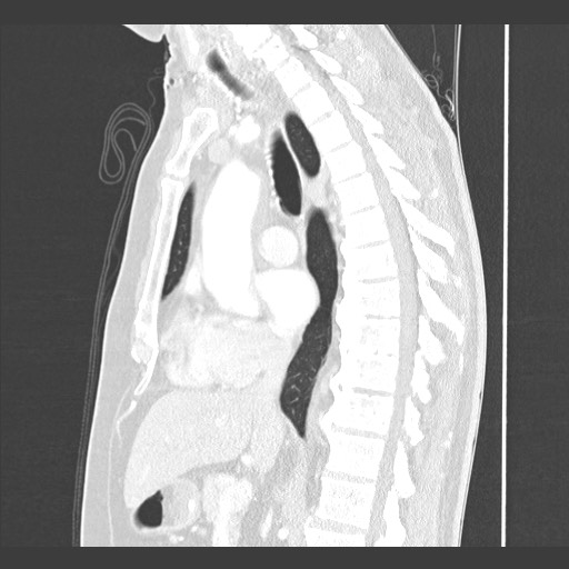 Adenocarcinoma of the lung (Radiopaedia 59871-67325 Sagittal lung window 49).jpg