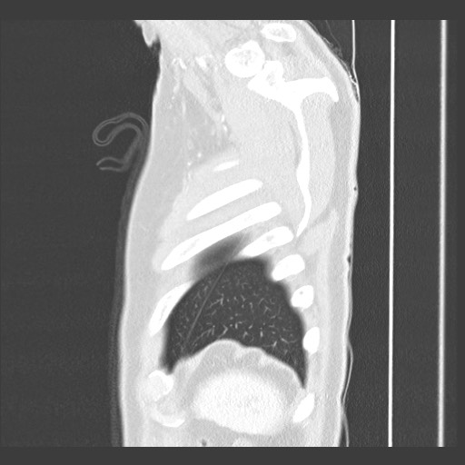Adenocarcinoma of the lung (Radiopaedia 59871-67325 Sagittal lung window 95).jpg