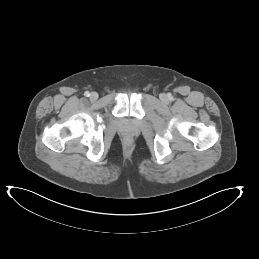 Adenocarcioma of rectum- T1 lesion (Radiopaedia 36921-38547 Axial C+ portal venous phase 90).png