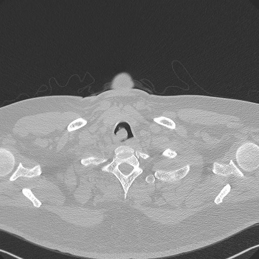 File:Adenoid cystic carcinoma of the trachea (Radiopaedia 49042-54137 Axial lung window 15).jpg