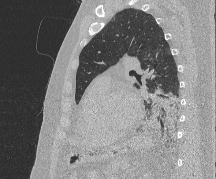 File:Adenoid cystic carcinoma of the trachea (Radiopaedia 49042-54137 Sagittal lung window 303).jpg