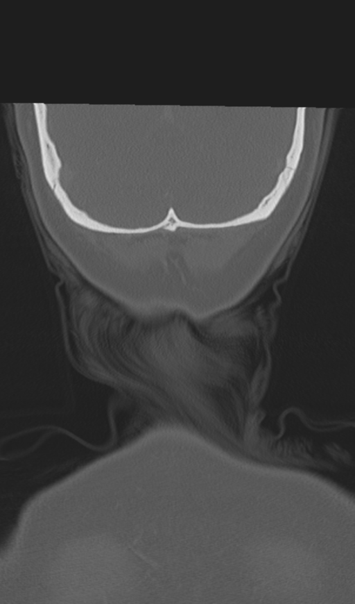 Adenoid cystic tumor of palate (Radiopaedia 46980-51518 Coronal bone window 59).png