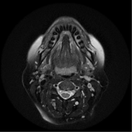 File:Adenoid cystic tumor of palate (Radiopaedia 46980-51519 Axial T2 14).png