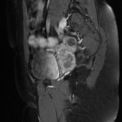 File:Adenoma malignum of cervix (Radiopaedia 66441-75705 Sagittal T1 C+ fat sat 18).jpg