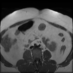 File:Adenomyosis within a didelphys uterus (Radiopaedia 70175-80215 Axial T1 4).jpg