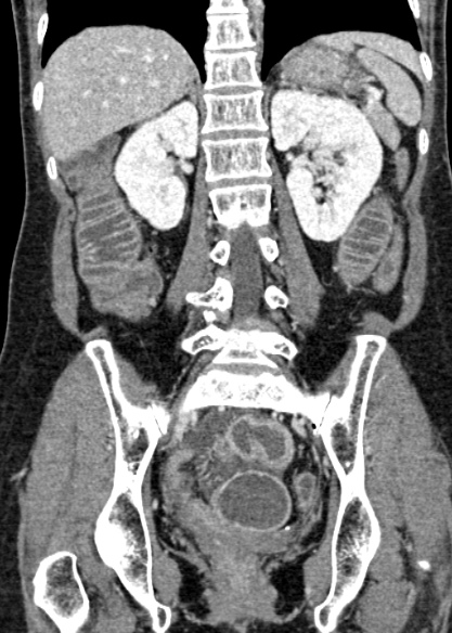 Adhesional small bowel obstruction (Radiopaedia 48397-53305 Coronal C+ portal venous phase 233).jpg