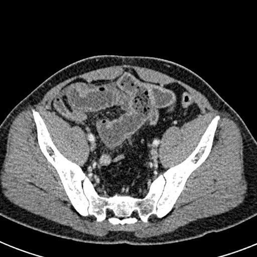 Adhesional small bowel obstruction (Radiopaedia 58900-66131 Axial C+ portal venous phase 43).jpg