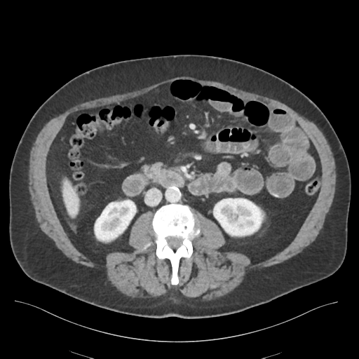 Adhesions within abdominal wall hernia (Radiopaedia 58283-65394 Axial C+ portal venous phase 41).png