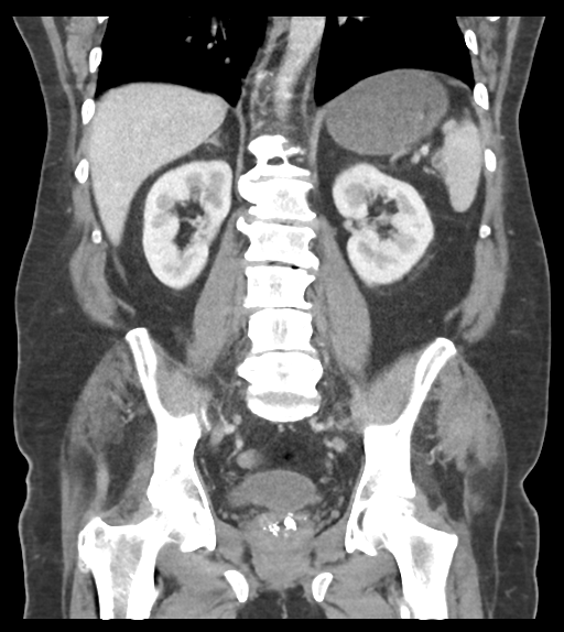 File:Adhesions within abdominal wall hernia (Radiopaedia 58283-65394 Coronal C+ portal venous phase 47).png