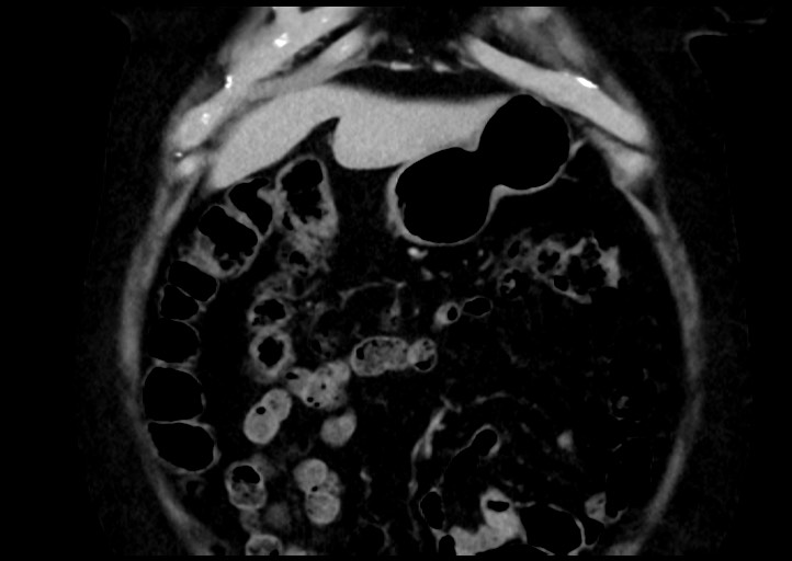 Adrenal cortical carcinoma (Radiopaedia 64017-72769 Coronal C+ portal venous phase 10).jpg
