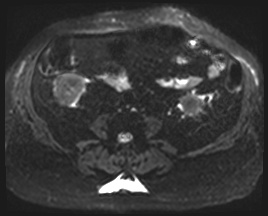 Adrenal cortical carcinoma (Radiopaedia 64017-72770 Axial DWI 37).jpg