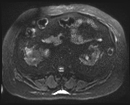 File:Adrenal cortical carcinoma (Radiopaedia 64017-72770 Axial DWI 66).jpg