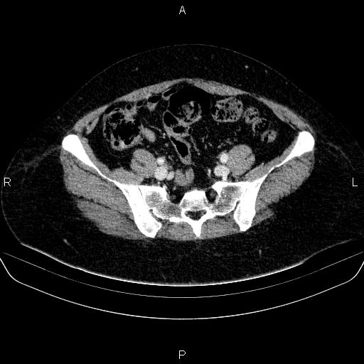 Adrenal cortical carcinoma (Radiopaedia 84882-100379 Axial C+ portal venous phase 72).jpg