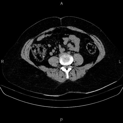 File:Adrenal cortical carcinoma (Radiopaedia 84882-100379 Axial non-contrast 57).jpg