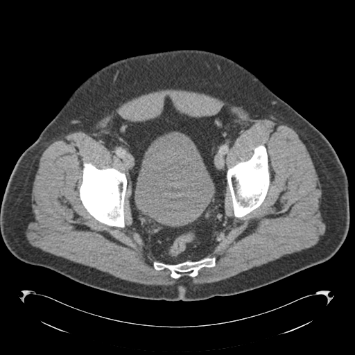 Adrenal cyst (Radiopaedia 45625-49776 Axial C+ portal venous phase 88).png