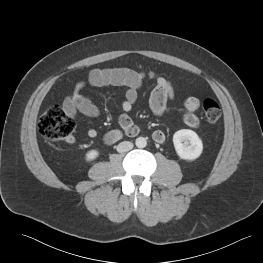 File:Adrenal cyst (Radiopaedia 45625-49777 Axial C+ portal venous phase 57).png