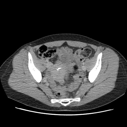 Adrenal cyst (Radiopaedia 64869-73813 Axial C+ portal venous phase 66).jpg