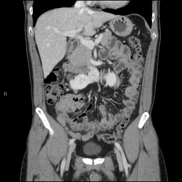 Adrenal cystic lymphangioma (Radiopaedia 83161-97534 Coronal C+ portal venous phase 29).jpg